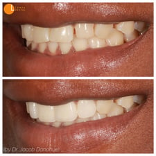 10Four veneers to improve shape, spacing, and chipping of four front teeth