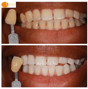 2Teeth whitening can be life-changing - this was done with KoR whitening