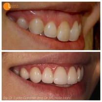 5Gum lift and veneers on eight teeth to fix a gummy smile and improve lip support