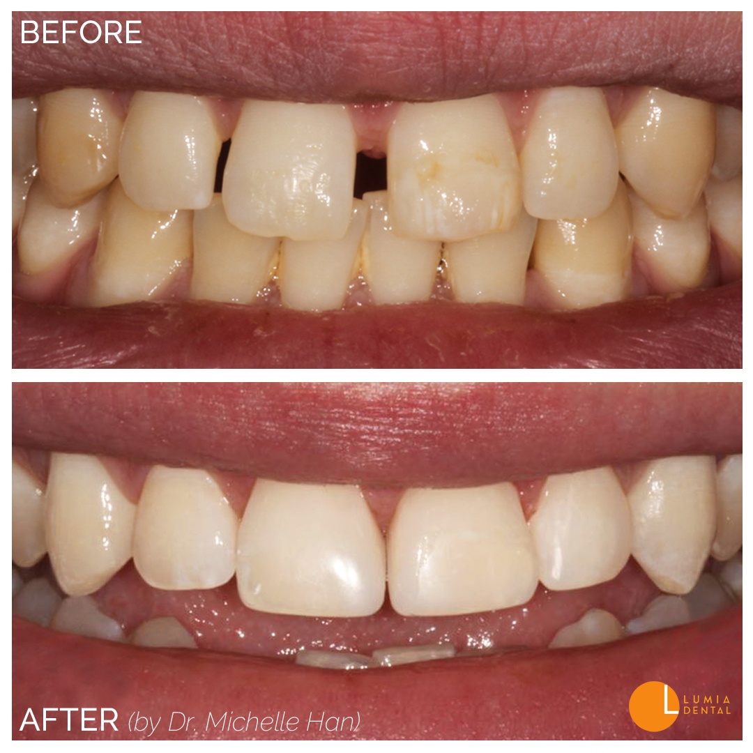 Bonding tooth gap June 2018