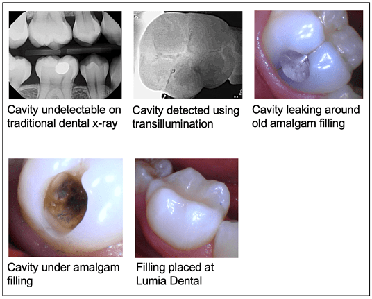 Cavity