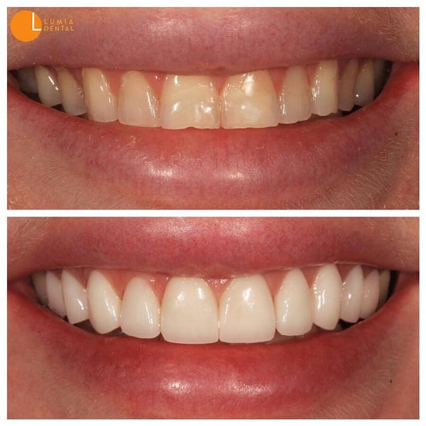 Porcelain-Veneers-and-Crowns-1