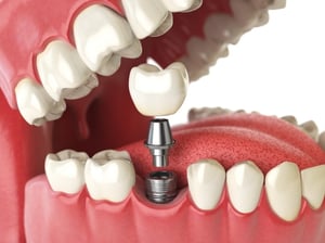 Dental Surgery and Implants NYC