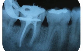 endodontics-root-canal-nyc-580x360-1
