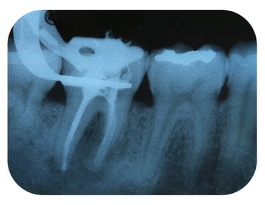 Endodontics Root Canal NYC