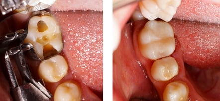General Restorative Dentistry NYC