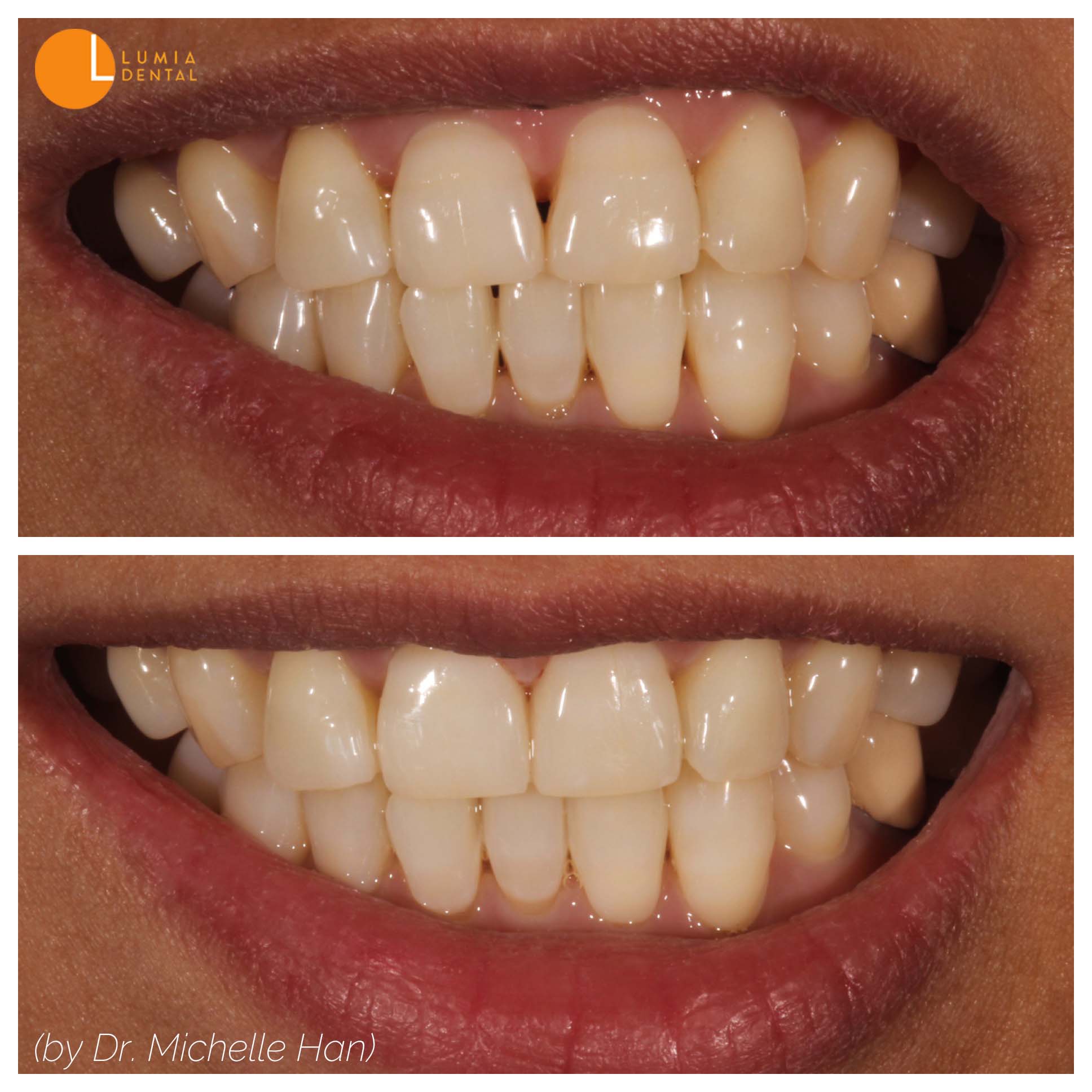 Before & after photos of our satisfied patients - Smile gallery from ...