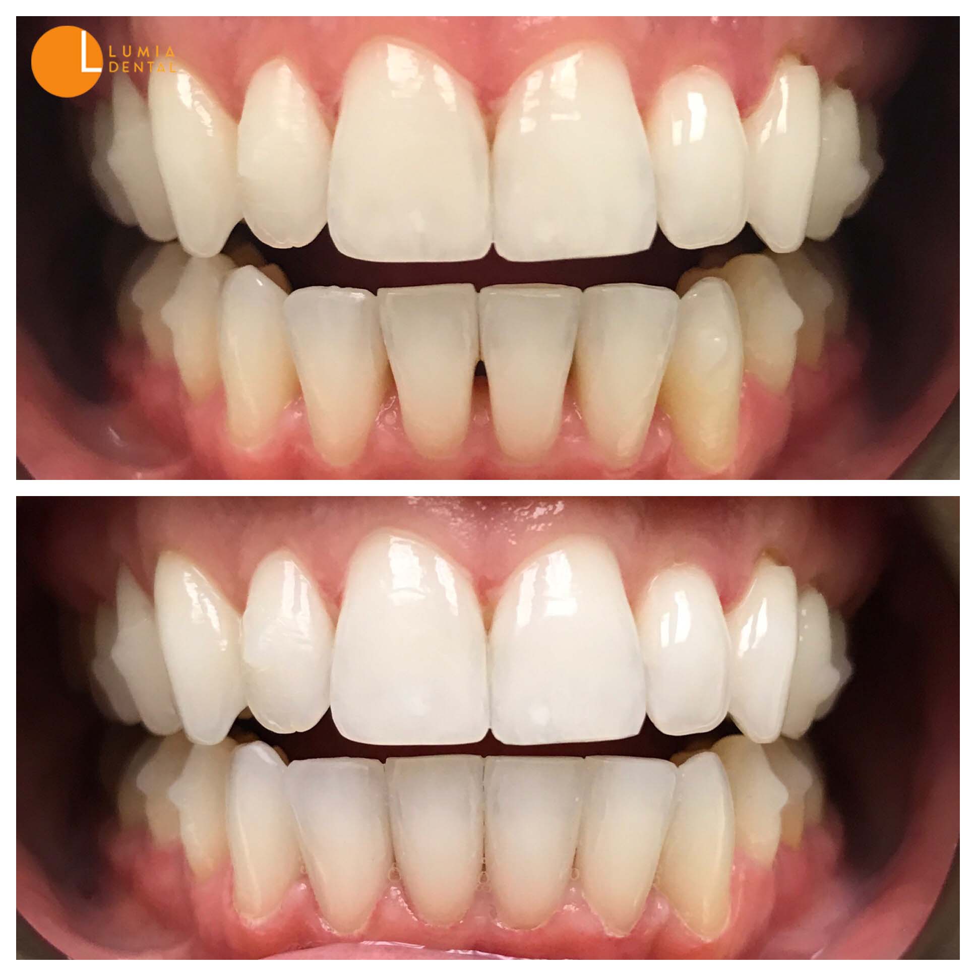 Before & after photos of our satisfied patients - Smile gallery from ...