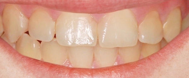 Courtesy of Icon - Needle free an drill free cavity treatment AFTER