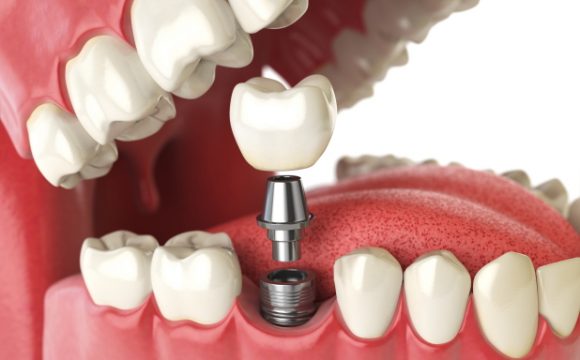 Dental Implants And Surgery