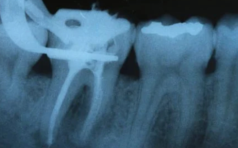 endodontics-root-canal-nyc-580x360-2