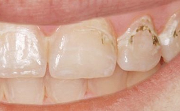 needle-free-cavity-filling-before-nyc-580x235-1