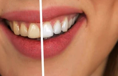 teeth-whitening-387x250