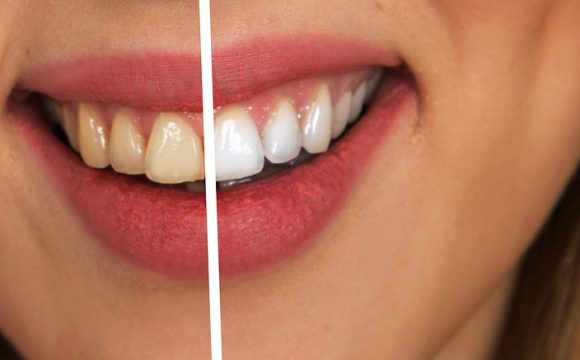 teeth-whitening-580x360 teeth-whitening-580x360